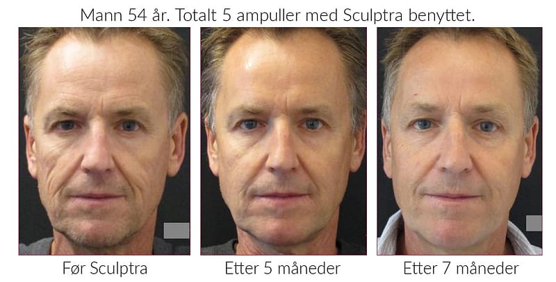 Sculptra Mann